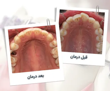 نمای اکلوزال فک پایین قبل و بعد از درمان ارتودنسی در بیمار 35 ساله و اصلاح نامرتبی دندان ها