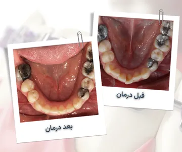 نمای اکلوزال فک پایین قبل و بعد از درمان ارتودنسی در بیمار 35 ساله و اصلاح نامرتبی دندان ها