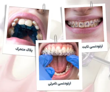 کلاژ مقایسه ای شامل ارتودنسی ثابت با براکت، پلاک متحرک ارتودنسی و ارتودنسی نامرئی برای آشنایی با روش های مختلف درمان ناهنجاری های دندانی