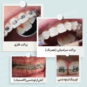 مقایسه اجزای ارتودنسی ثابت شامل براکت فلزی، براکت سرامیکی همرنگ دندان، اورینگ و کش ارتودنسی