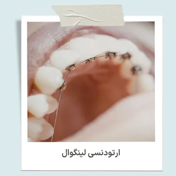 ارتودنسی لینگوال با براکت های نصب شده در سطح داخلی و پشت دندان ها