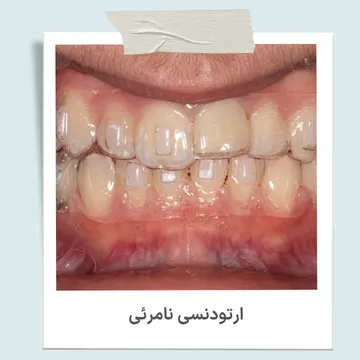 ارتودنسی نامرئی با الاینر شفاف برای مرتب کردن دندان ها بدون براکت فلزی
