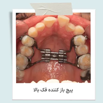 پیچ باز کننده فک بالا در ارتودنسی برای افزایش عرض فک و درمان تنگی فک بالا