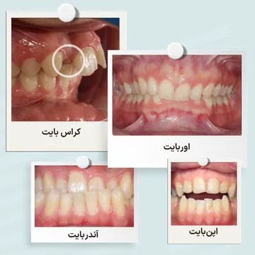 مقایسه انواع ناهنجاری های بایت شامل اوربایت، آندربایت، اپن بایت و کراس بایت که با ارتودنسی قابل درمان هستند