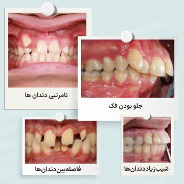 نمونه ای از مشکلات قابل درمان با ارتودنسی شامل جلو بودن فک، فاصله بین دندان ها، شیب زیاد دندان ها و نامرتبی دندان ها