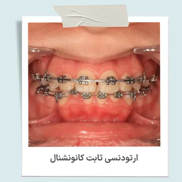 ارتودنسی ثابت کانونشنال با براکت فلزی و سیم ارتودنسی روی دندان ها
