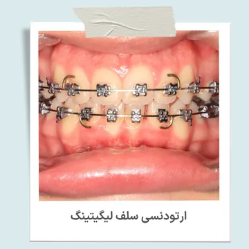 براکت سلف لیگیتینگ دیمون که سیم ارتودنسی را بدون استفاده از اورینگ نگه می دارد