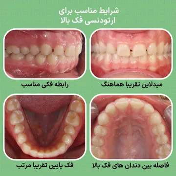 رابطه فکی مناسب، میدلاین هماهنگ و نامرتبی خفیف تا متوسط دندان های فک بالا در بیماری با فک پایین مرتب؛ نمونه ای از شرایط قابل درمان با ارتودنسی فک بالا