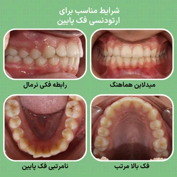 بایت طبیعی و فک بالای مرتب در کنار نامرتبی دندان های فک پایین؛ نمونه ای از شرایط مناسب برای ارتودنسی فک پایین