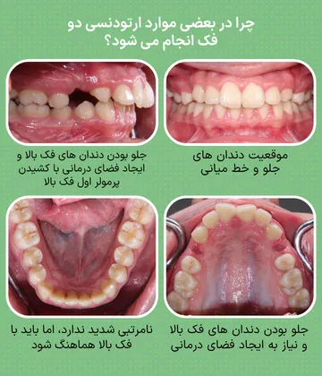 بیمار با جلو بودن دندان های فک بالا و کشیدن پرمولرهای اول فک بالا برای ایجاد فضای درمانی؛ نمونه ای از شرایطی که ممکن است درمان هر دو فک توصیه شود