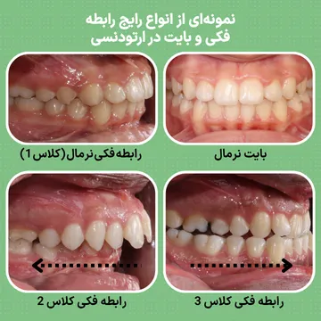 تصویر آموزشی انواع بایت در ارتودنسی شامل کلاس 1، کلاس 2 و کلاس 3 و تفاوت رابطه دندان های فک بالا و پایین