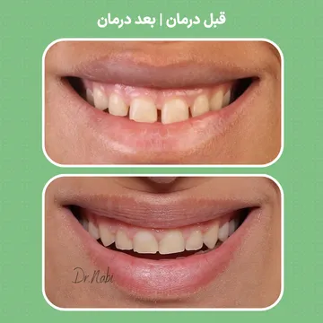 عکس قبل و بعد ارتودنسی فک بالا با بهبود نظم دندان ها و زیبایی لبخند