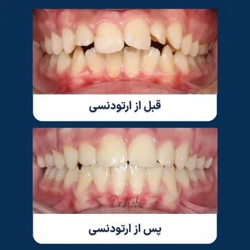 مقایسه نمای داخل دهانی بیمار قبل و بعد از درمان ارتودنسی برای اصلاح شلوغی و نامرتبی دندان ها و بهبود نظم قوس دندانی.