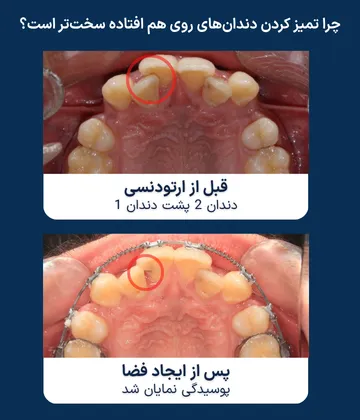نمایان شدن پوسیدگی پنهان پس از ایجاد فضای ارتودنسی مقایسه قبل و بعد از ایجاد فضای ارتودنسی؛ در این بیمار، روی هم قرار گرفتن دندان ها باعث دشوار شدن تمیز کردن ناحیه شده بود و پس از ایجاد فضا، پوسیدگی پنهان بین دندان ها نمایان شد.