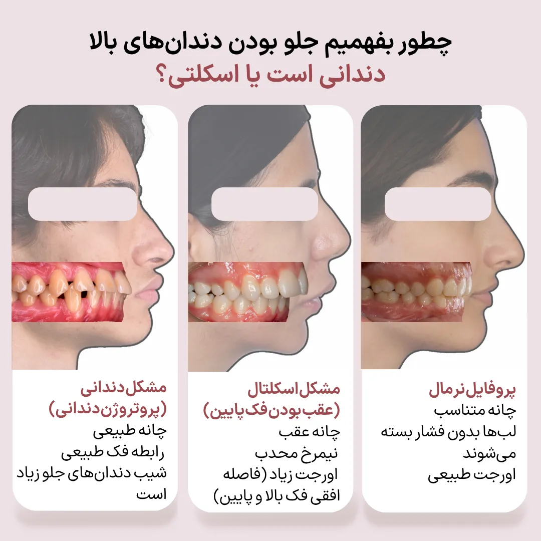 تشخیص علت جلو بودن دندان های بالا با مقایسه پروتروژن دندانی، مشکل اسکلتی و پروفایل طبیعی