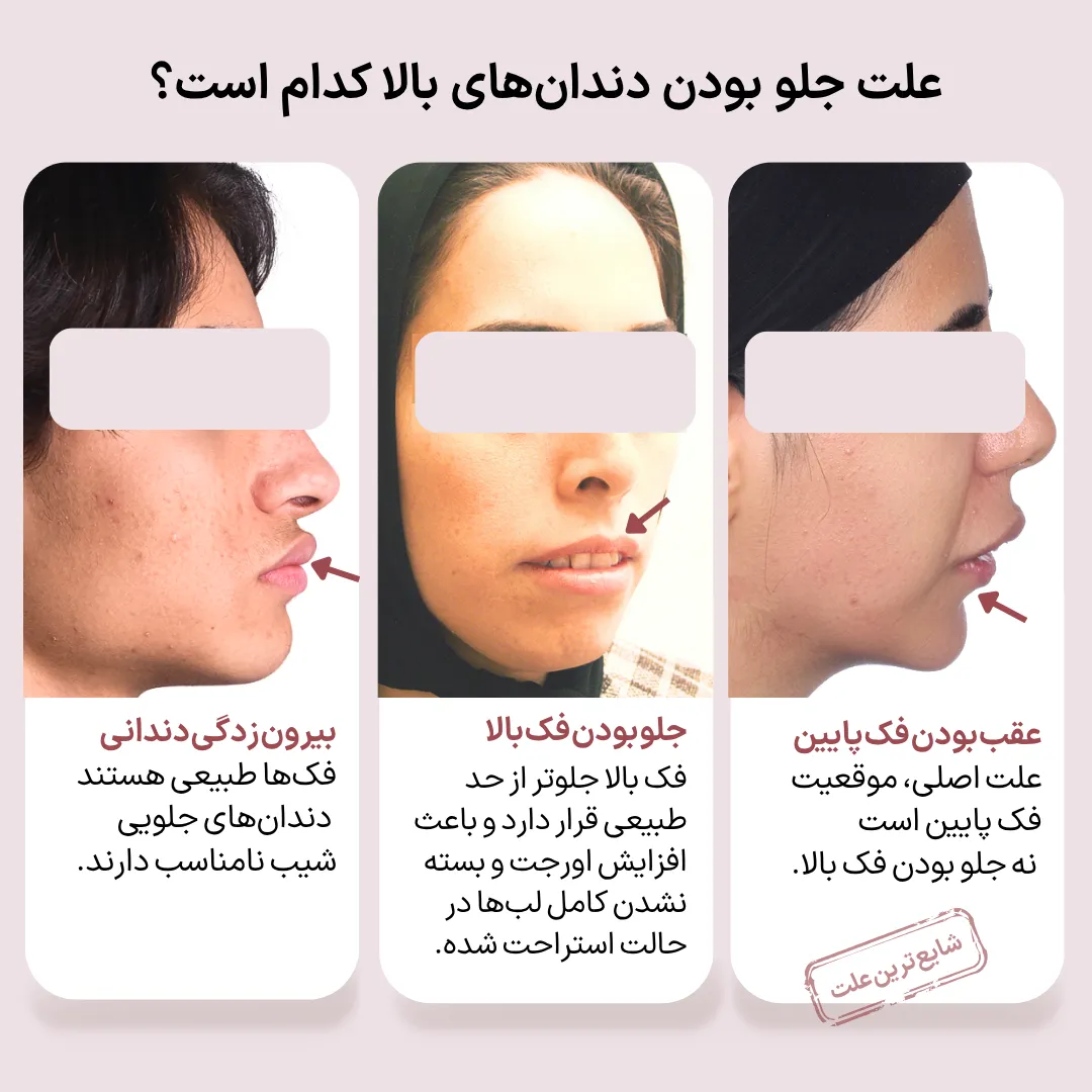 مقایسه علت های جلو بودن دندان های بالا شامل بیرون زدگی دندانی، جلو بودن فک بالا و عقب بودن فک پایین