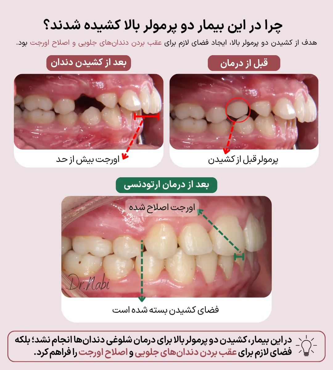 مقایسه قبل و بعد درمان ارتودنسی بیماری که برای اصلاح اورجت و عقب بردن دندان های جلویی، دو پرمولر بالا کشیده شده است.