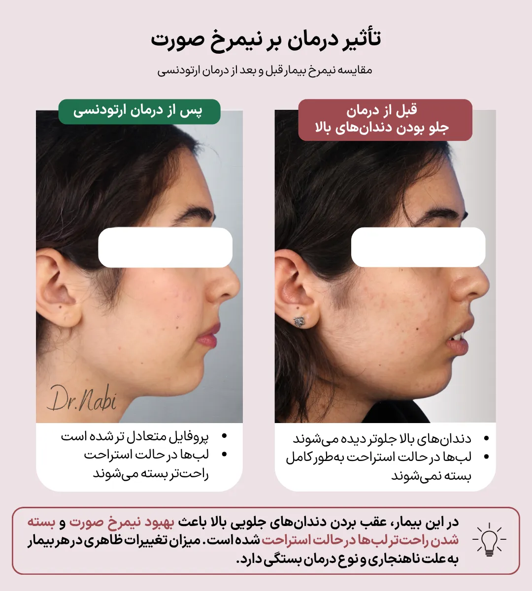 مقایسه نیمرخ بیمار قبل و بعد از درمان جلو بودن دندان های بالا که بهبود وضعیت لب ها و متعادل تر شدن پروفایل صورت را نشان می دهد.