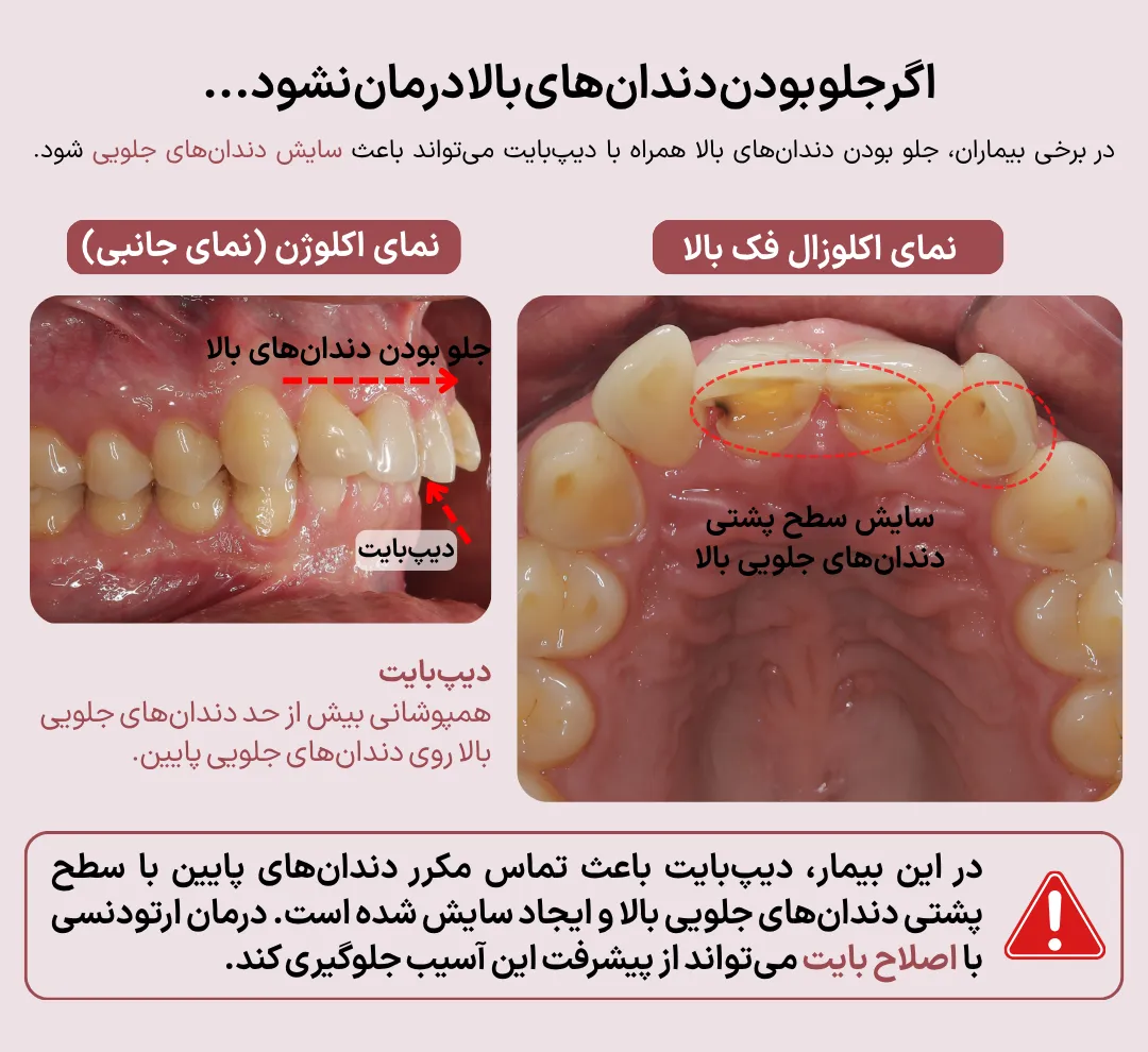 تصاویر بیماری با جلو بودن دندان های بالا و دیپ بایت که باعث سایش سطح پشتی دندان های جلویی شده است.