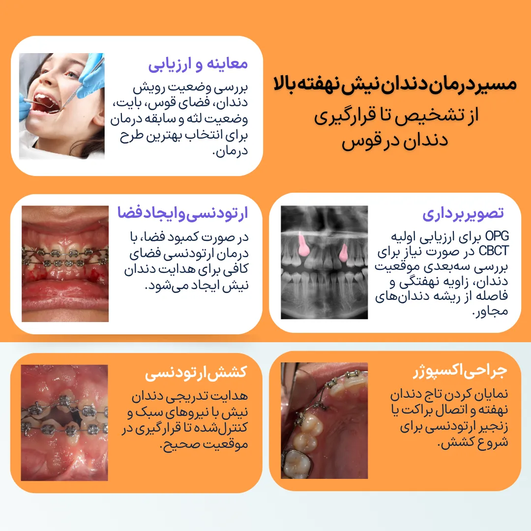 اینفوگرافیک مراحل درمان دندان نیش نهفته بالا شامل معاینه، تصویربرداری OPG یا CBCT، ایجاد فضا با ارتودنسی، جراحی اکسپوژر و کشش تدریجی دندان