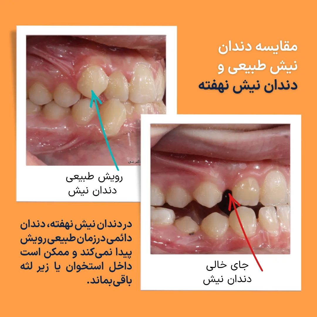 مقایسه نمای داخل دهان بیمار با دندان نیش طبیعی و بیمار دارای دندان نیش نهفته بالا که دندان نیش دائمی رویش نیافته است.