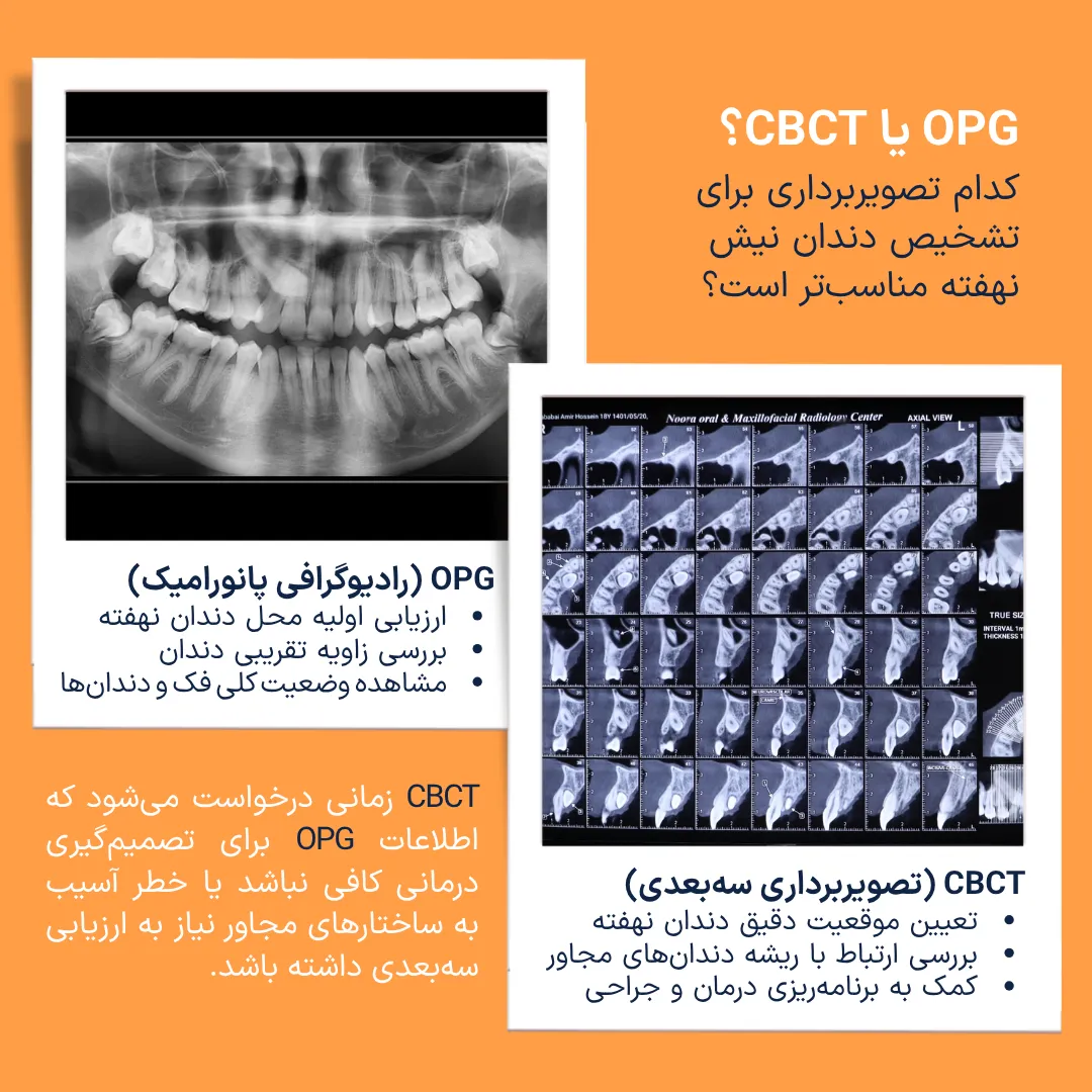 مقایسه رادیوگرافی پانورامیک OPG و تصویربرداری سه بعدی CBCT برای ارزیابی موقعیت دندان نیش نهفته بالا و بررسی ارتباط آن با ریشه دندان های مجاور.