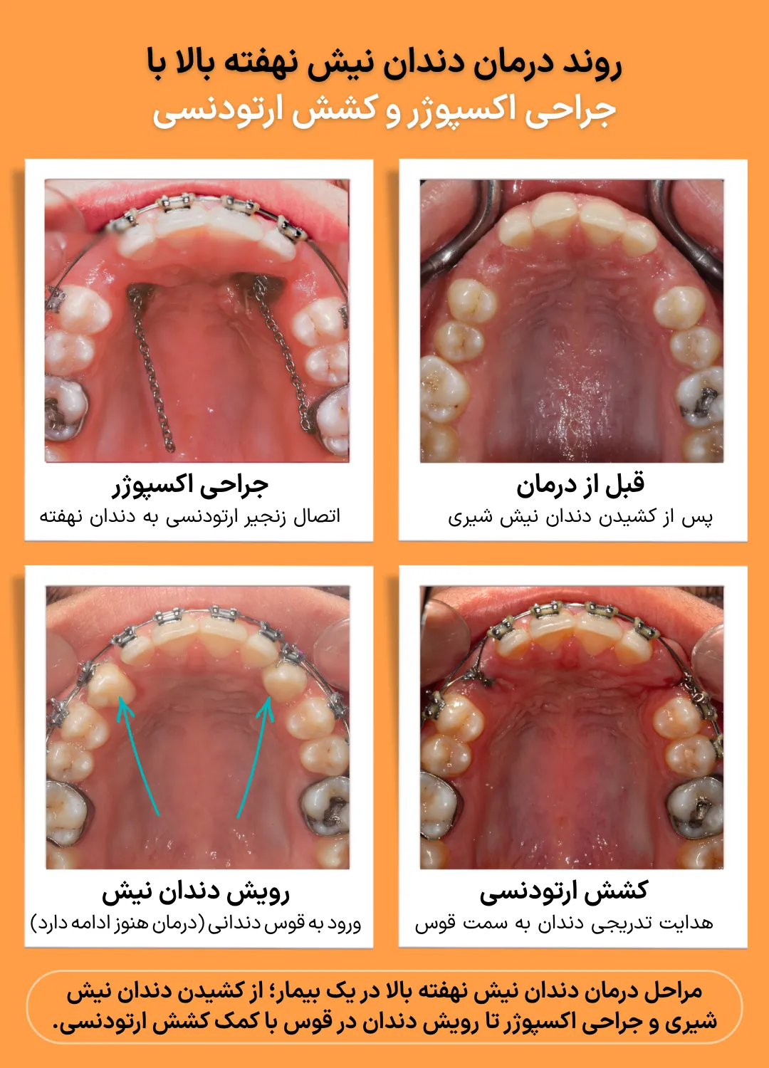 تصاویر مرحله به مرحله درمان دندان نیش نهفته بالا شامل کشیدن دندان نیش شیری، جراحی اکسپوژر، کشش ارتودنسی و رویش دندان نیش در قوس دندانی.