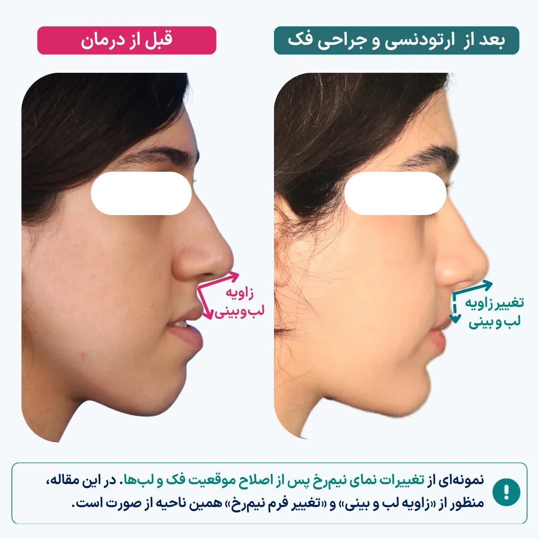 مقایسه نمای نیم رخ بیمار قبل از درمان و بعد از ارتودنسی و جراحی فک برای نمایش تغییر زاویه لب و بینی و تأثیر آن بر تناسب ظاهری صورت؛ بیمار جراحی بینی انجام نداده است.