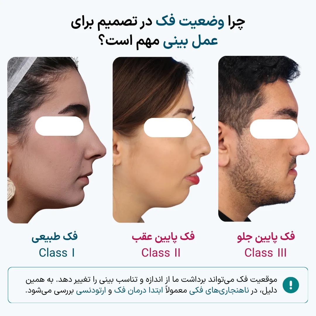 مقایسه سه نمای نیم رخ شامل فک طبیعی، فک پایین عقب و فک پایین جلو که نشان می دهد موقعیت فک چگونه می تواند بر تناسب ظاهری بینی و تعادل صورت تأثیر بگذارد.