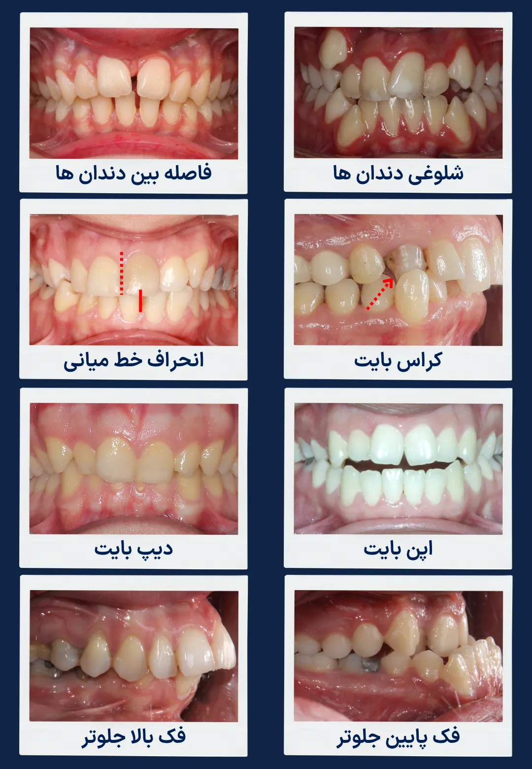 اینفوگرافیک انواع ناهنجاری های قابل درمان با ارتودنسی بزرگسالان شامل شلوغی دندان ها، فاصله بین دندان ها، کراس بایت، دیپ بایت، اپن بایت، اوربایت، آندربایت و انحراف خط میانی