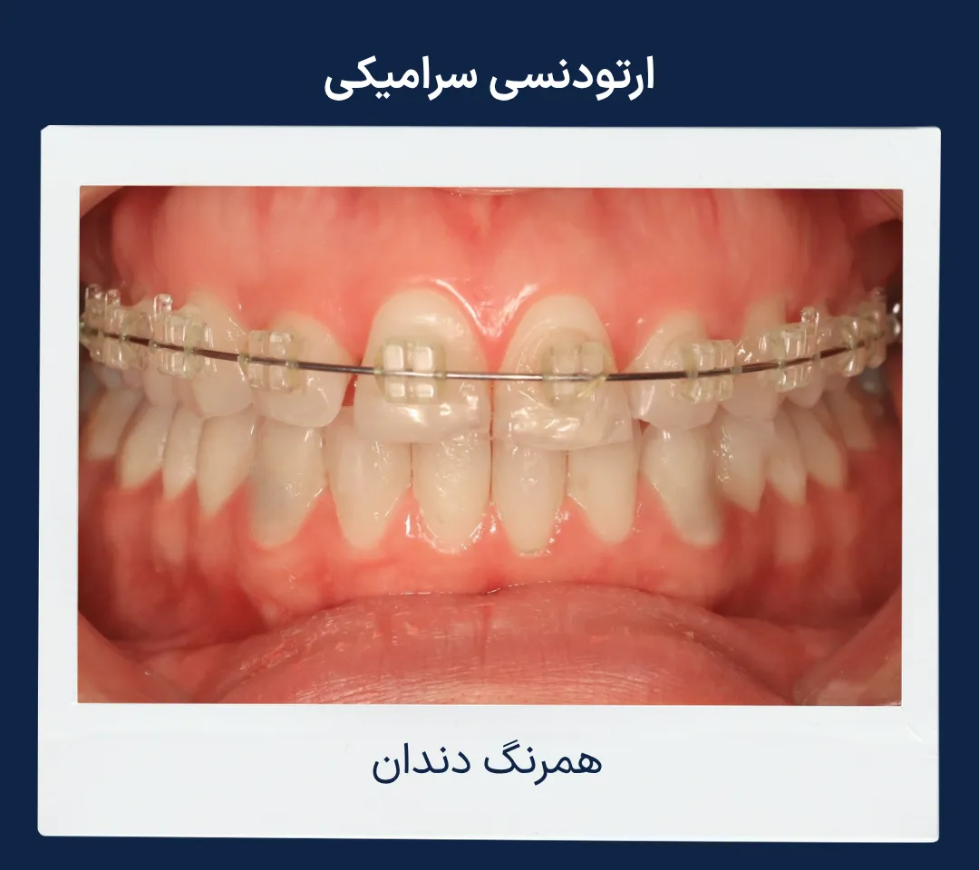 براکت سرامیکی همرنگ دندان برای ارتودنسی بزرگسالان با ظاهر کمتر قابل مشاهده
