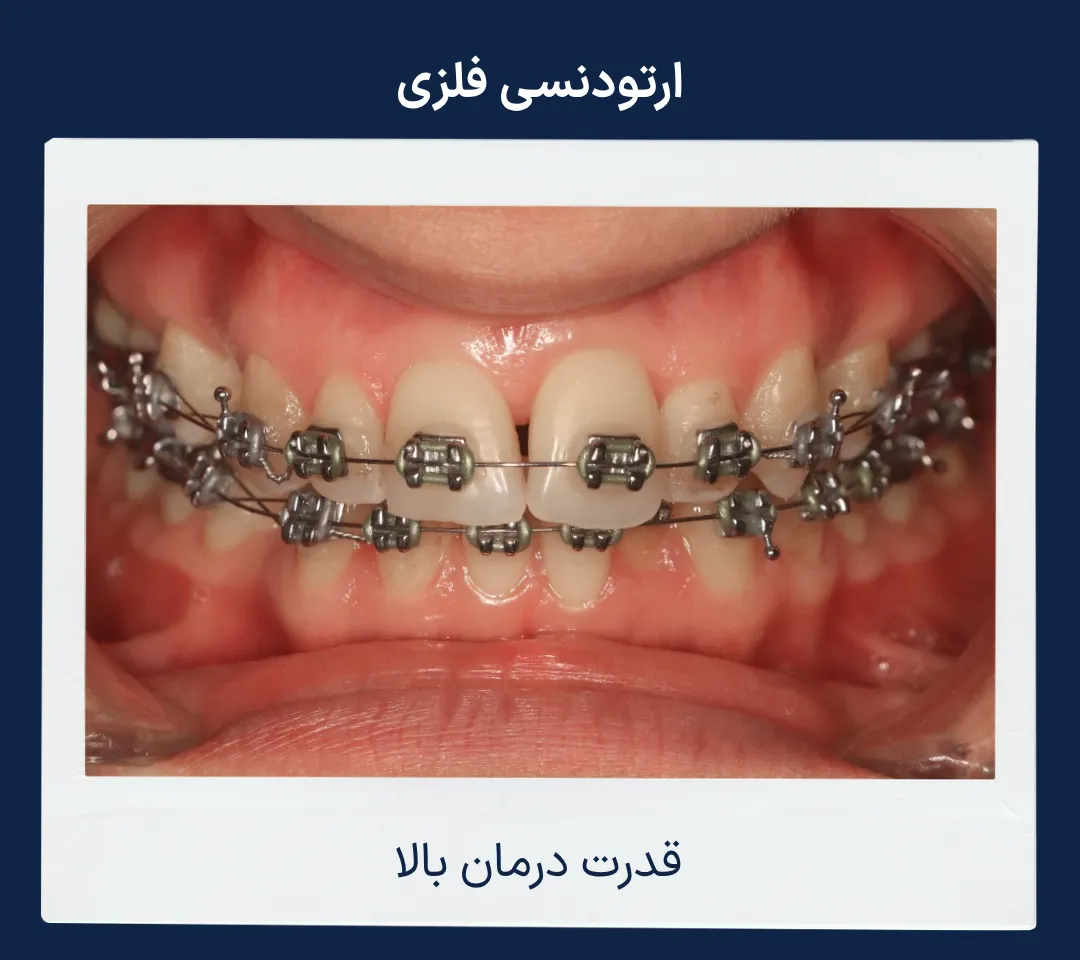نمای نزدیک براکت فلزی مورد استفاده در درمان انواع ناهنجاری های دندانی