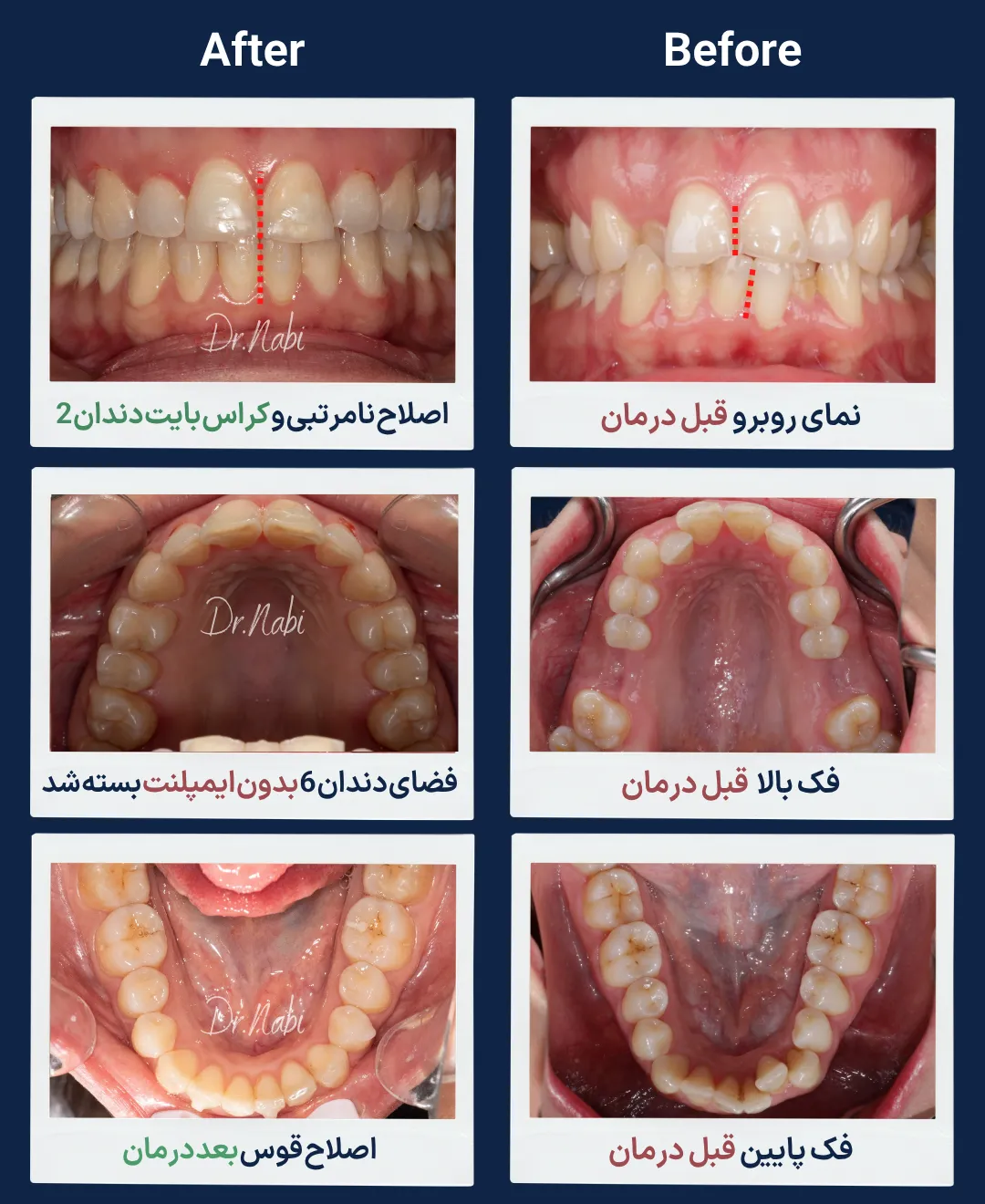 قبل و بعد درمان ارتودنسی بزرگسالان با اصلاح نامرتبی دندان ها، اصلاح کراس بایت دندان 2 و بسته شدن فضای دو دندان 6 فک بالا بدون نیاز به ایمپلنت