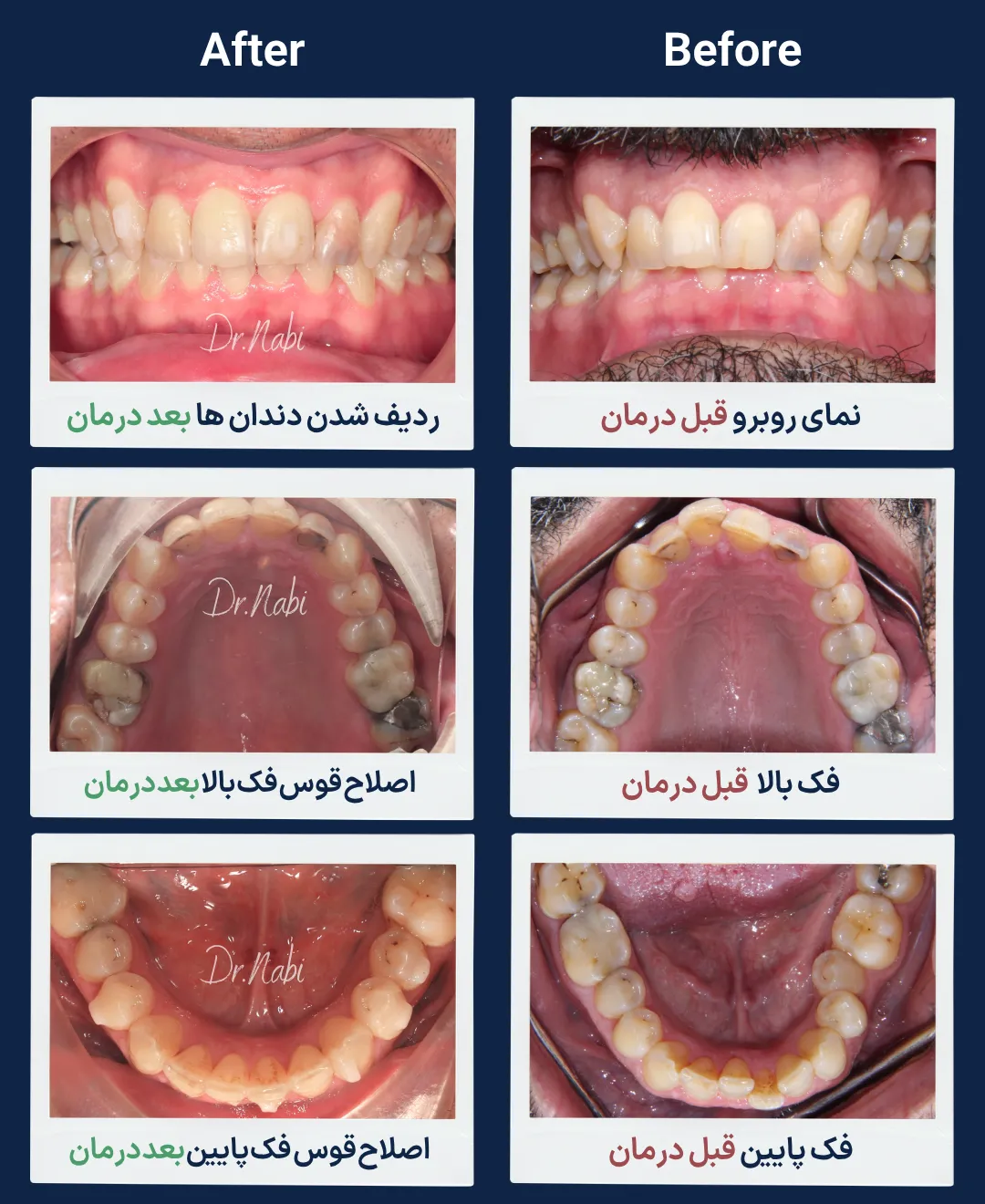 قبل و بعد درمان ارتودنسی نامرئی در بیمار 52 ساله با الاینر شفاف، اصلاح نامرتبی و چرخش دندان ها و هماهنگ شدن قوس دندانی