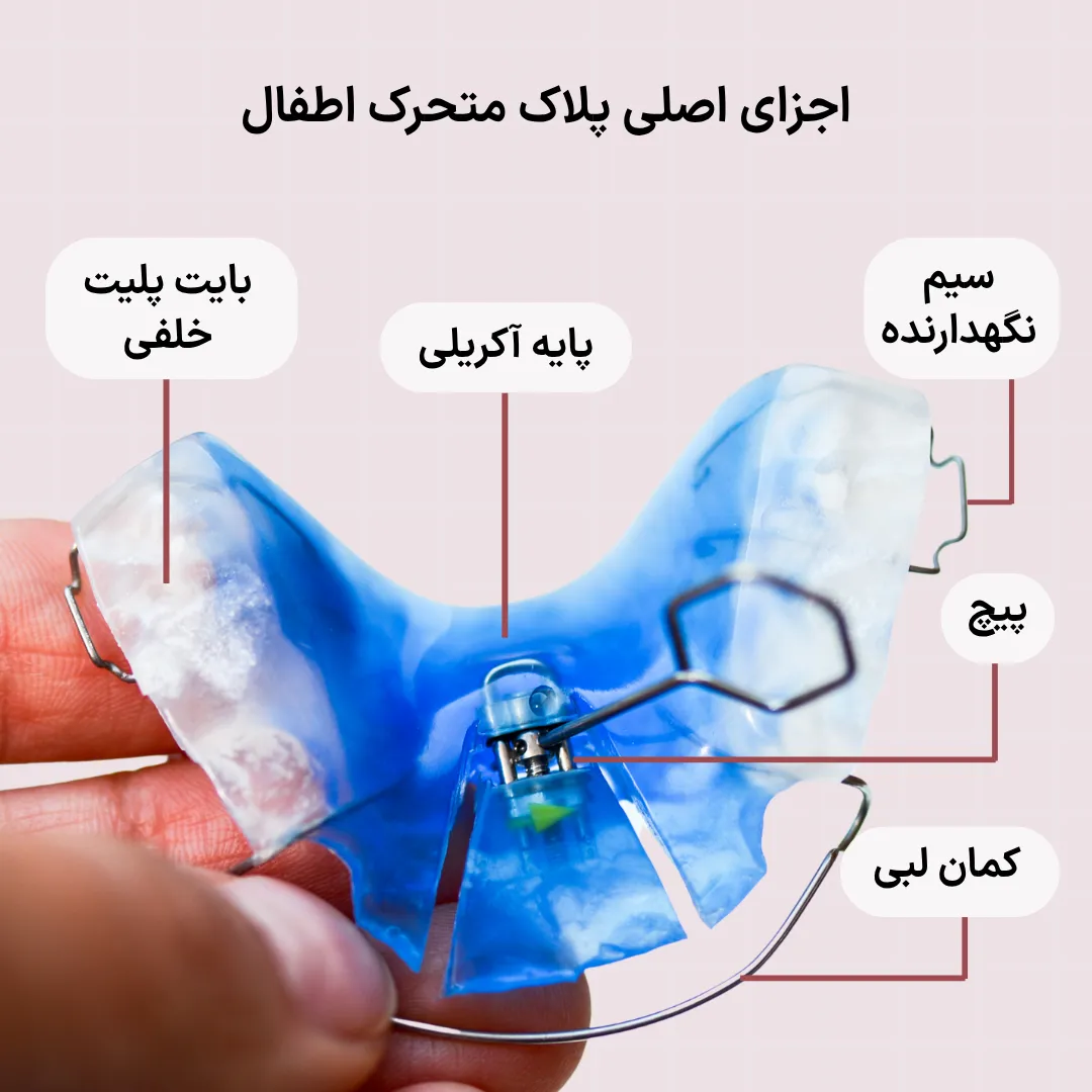 اجزای پلاک متحرک اطفال و کاربرد هر بخش تصویر آموزشی اجزای پلاک متحرک اطفال شامل پایه آکریلی، پیچ گسترش، کمان لبی، سیم نگهدارنده و بایت پلیت خلفی