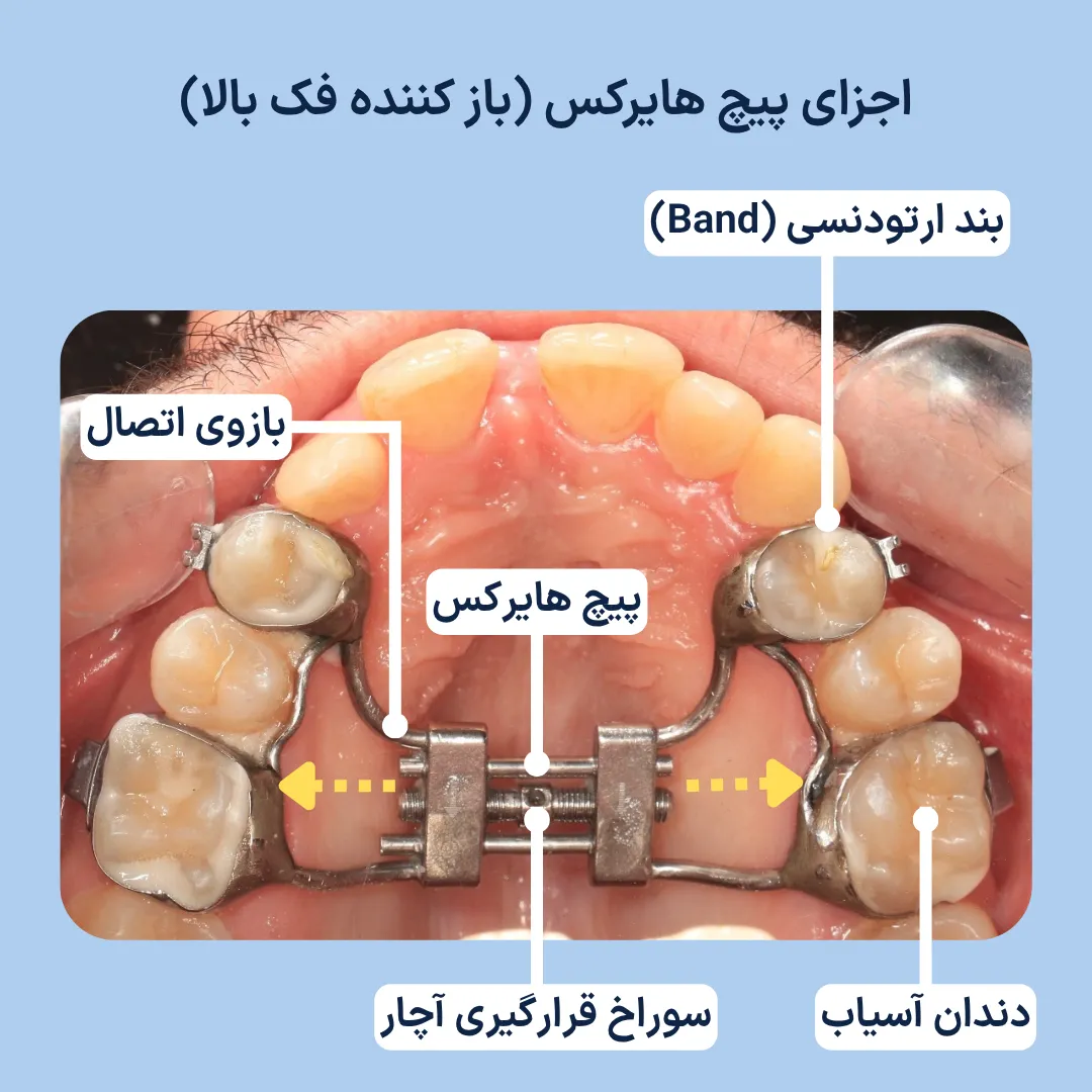 اجزای دستگاه هایرکس برای درمان تنگی فک بالا شامل بند ارتودنسی، پیچ، بازوی اتصال و محل قرارگیری آچار