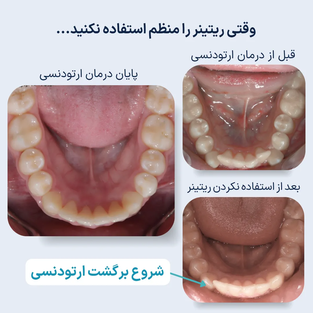 نمونه واقعی برگشت ارتودنسی؛ مقایسه قبل از درمان، پایان درمان و حرکت مجدد دندان ها پس از استفاده نکردن از ریتینر