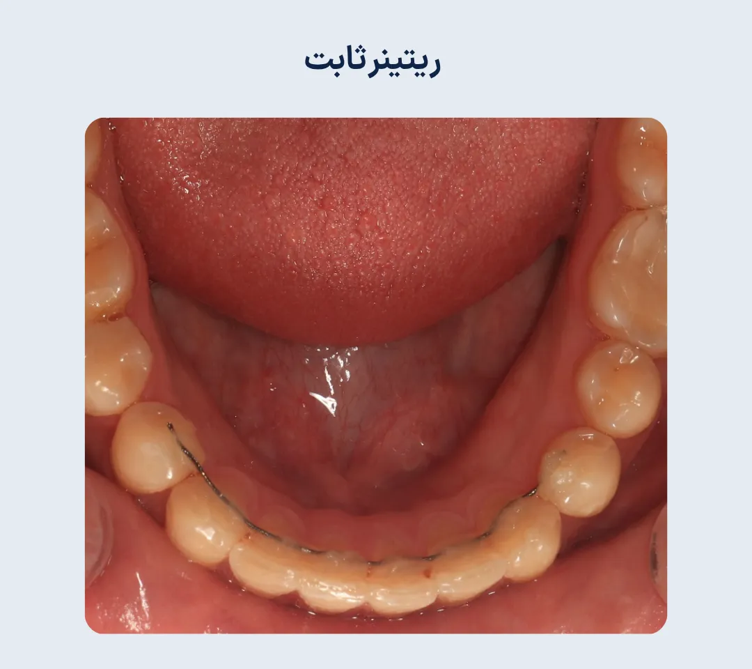 تصویر ریتینر ثابت پشت دندانهای فک پایین که پس از پایان درمان ارتودنسی برای حفظ موقعیت دندانها استفاده می شود.