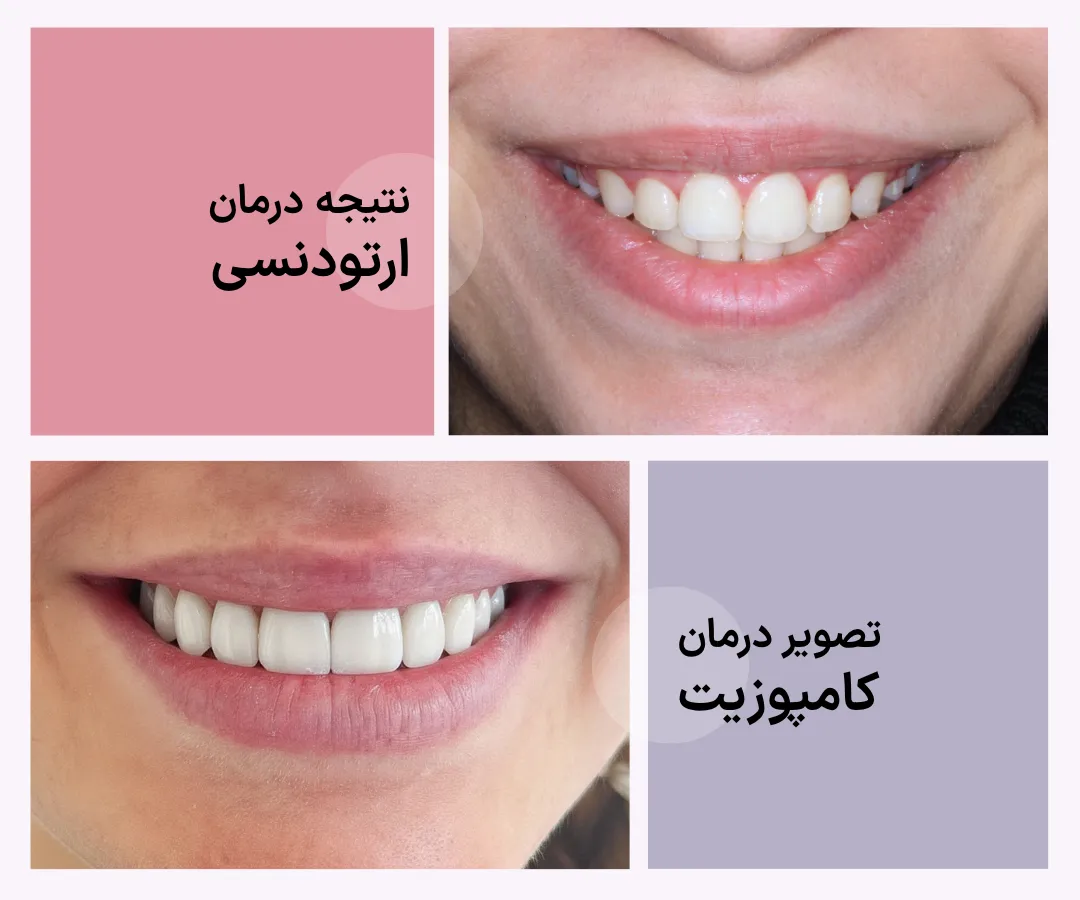 مقایسه نتیجه ارتودنسی واقعی با نمونه کامپوزیت دندانی برای نمایش تفاوت درمان