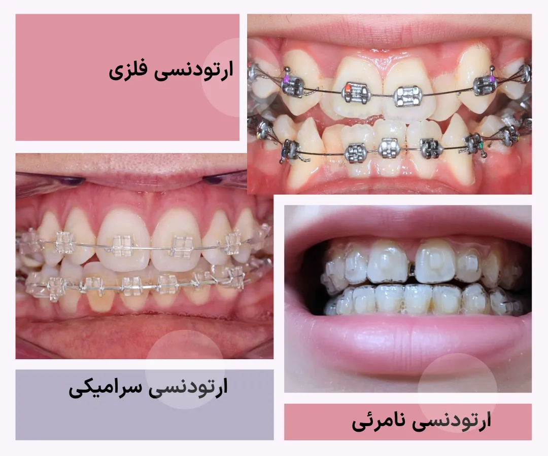 تصویر مقایسه ای انواع ارتودنسی شامل ارتودنسی فلزی، ارتودنسی سرامیکی و ارتودنسی نامرئی با الاینر شفاف