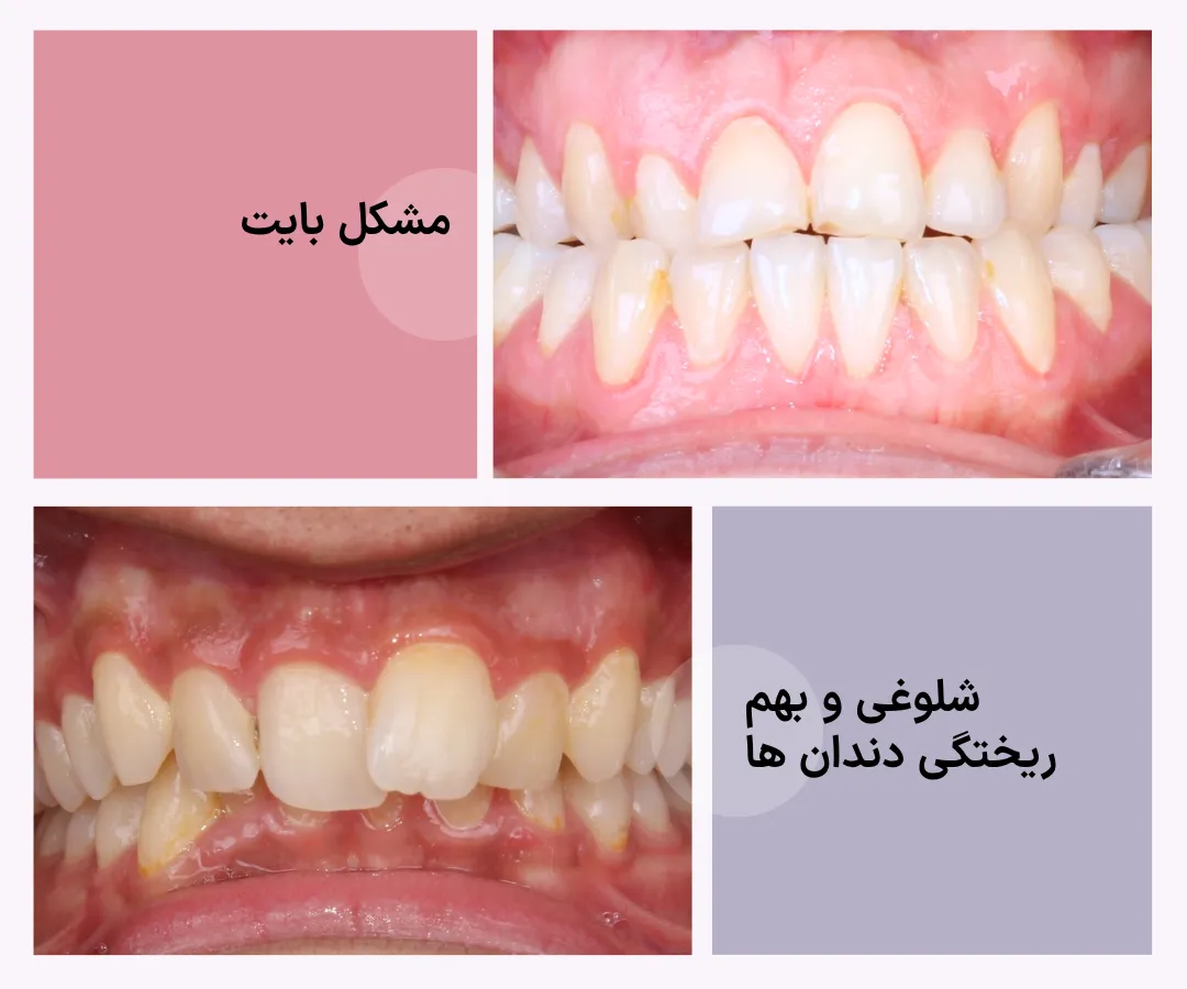 تصویر آموزشی از موارد نامناسب برای درمان با کامپوزیت شامل نامرتبی شدید دندان ها، شلوغی دندانی و مشکلات بایت که معمولاً به ارتودنسی نیاز دارند.