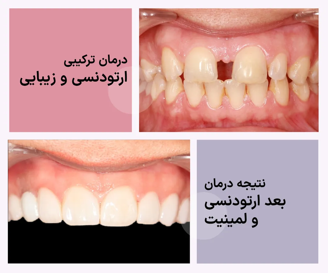 مقایسه نمای روبروی دندان ها قبل از درمان و نتیجه نهایی پس از ارتودنسی و لمینیت