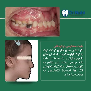 نمای داخل دهان و نیم رخ کودک با جلو بودن فک پایین در کلاس 3
