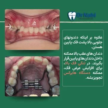 نمای داخل دهان کودک دارای تنگی فک بالا و دستگاه هایرکس