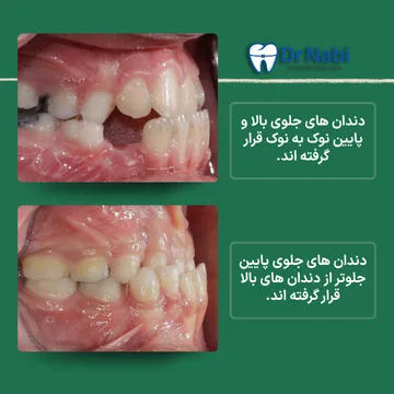 دو نمای داخل دهان با تماس نوک به نوک دندان های جلو و جلو بودن دندان های پایین