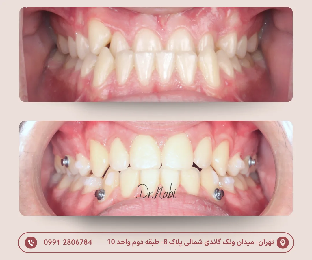 قبل و بعد اصلاح کراس بایت قدامی با ارتودنسی نامرئی